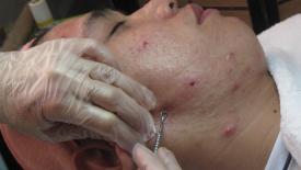 pimple-extraction.jpg